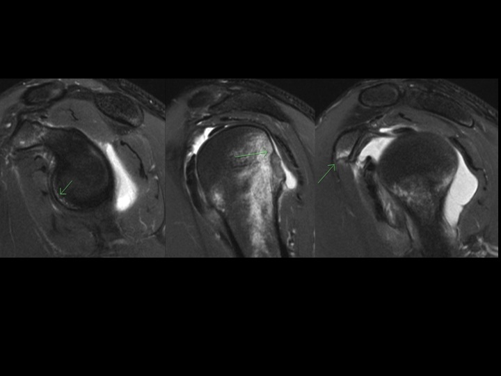 Figure 3 for case Perthes lesion